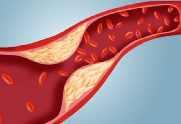 Χοληστερόλη, ο σιωπηλός εχθρός της υγείας σας