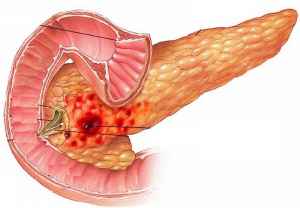 Τι πρέπει να γνωρίζετε για την οξεία παγκρεατίτιδα;